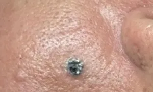 Phát hiện ung thư da từ nốt ruồi rỉ máu