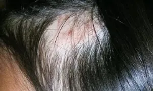 Nhổ tóc - rối loạn tâm thần cần được chữa trị